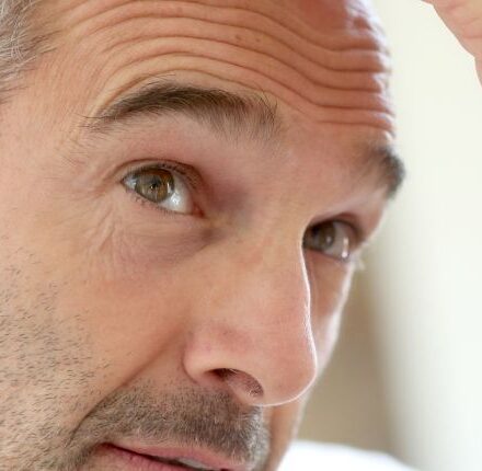 Guys: How to prevent hair loss